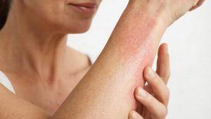 Пищевая аллергия как проявляется, симптомы и лечение у взрослых