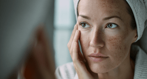 Удаление пигментных пятен