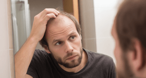 Облысение волос
