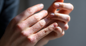 Диета при экземе