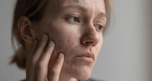 Избавиться от прыщей