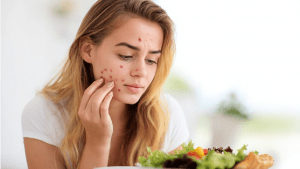 Диета при акне: что можно есть, меню и рекомендации