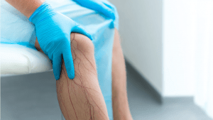 Венозная недостаточность нижних конечностей