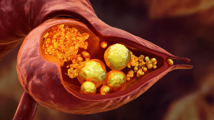 Диета при камнях в желчном пузыре