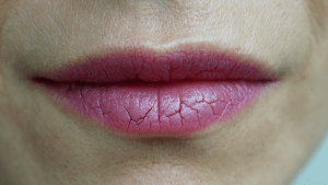 Трещины в уголках губ