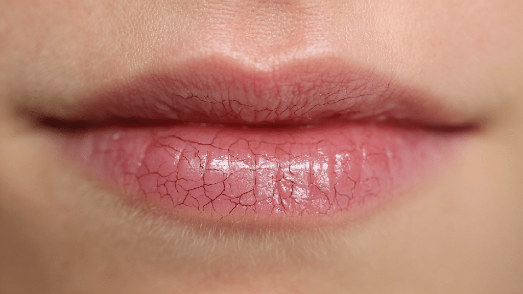 Трещины в уголках губ