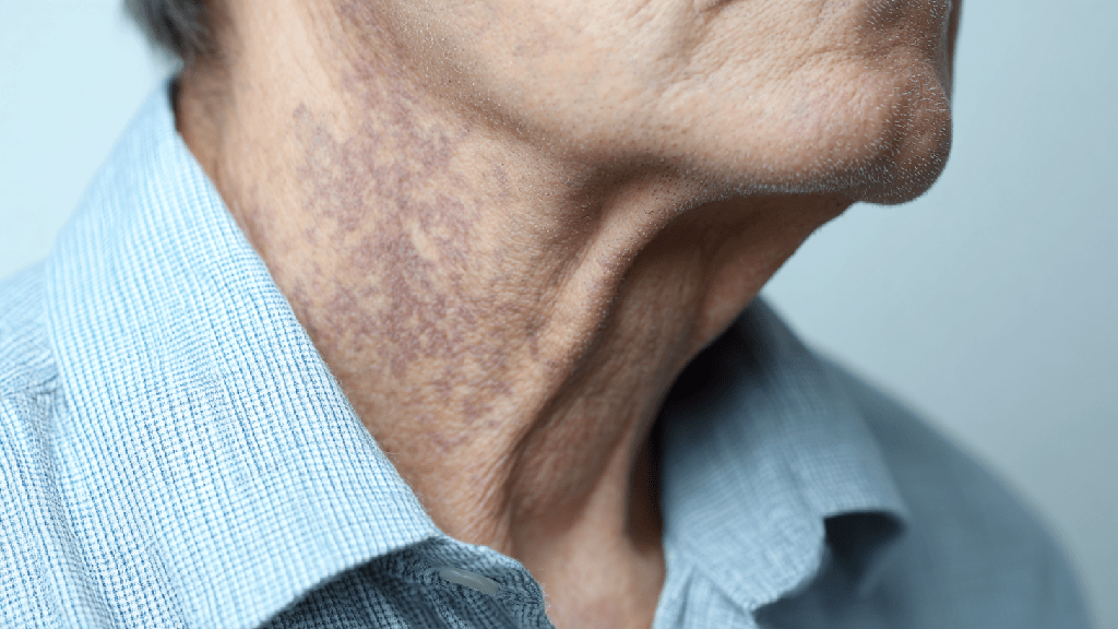 Опоясывающий лишай: симптомы, причины и лечение
