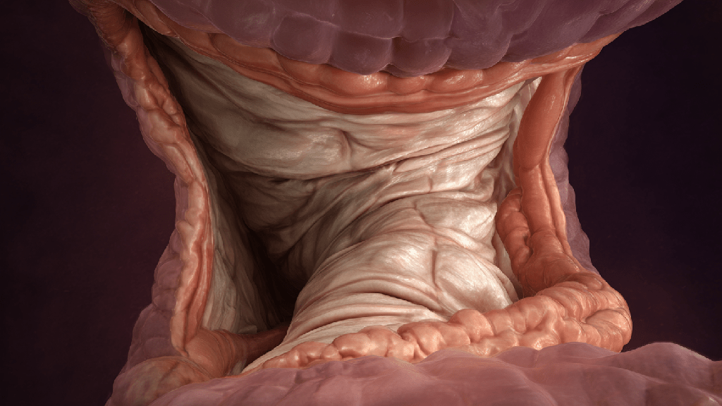 Грыжа пищеводного отверстия диафрагмы