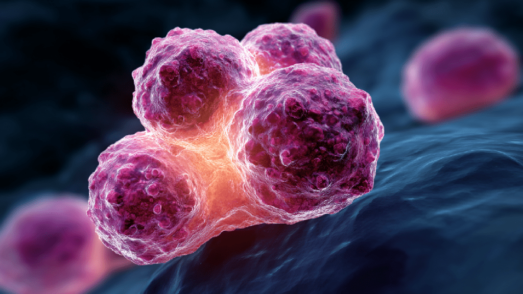 Саркома мягких тканей