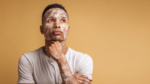 Диета при витилиго у взрослых