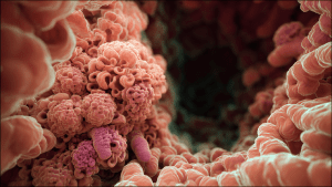 Полипы в кишечнике