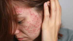 Атопический дерматит у взрослых