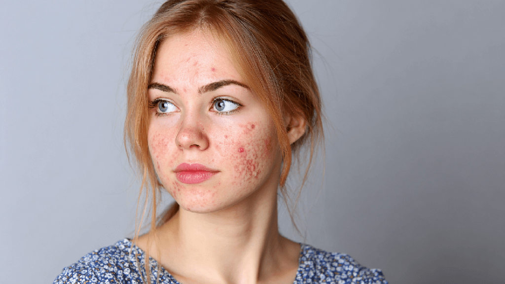 Атопический дерматит у взрослых