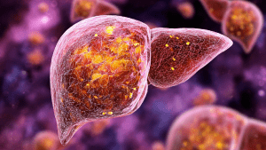 Жировой гепатоз печени