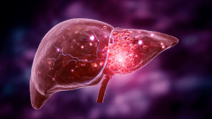 Абсцесс печени