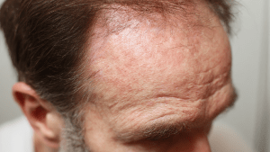 Диета при себорейном дерматите