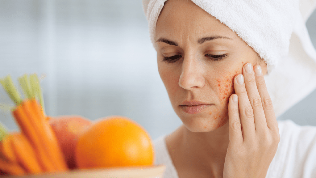 Диета при себорейном дерматите
