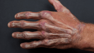 Межфаланговый артроз