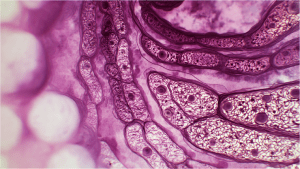 Микроскопический колит