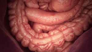 Атрофия слизистой желудка