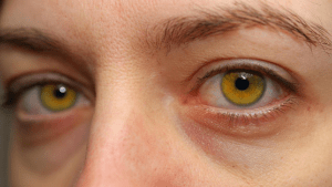 Основные и ранние симптомы желтухи у взрослых