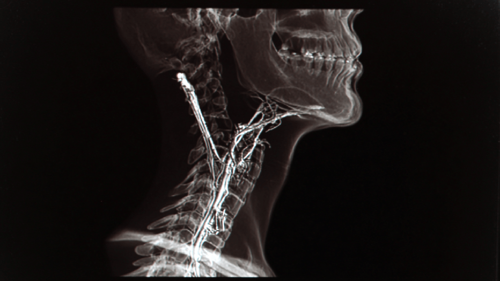 Ахалазия пищевода
