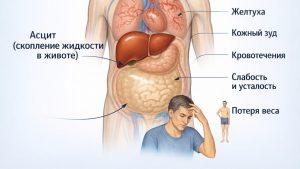 Цирроз печени – симптомы, причины, стадии и лечение