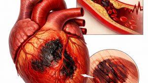 Диета после инфаркта