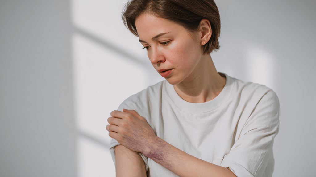 Синяки у женщин без причины: особенности и причины