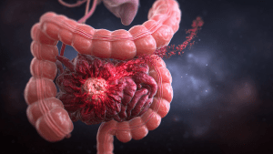 Язва 12-перстной кишки: признаки и лечение