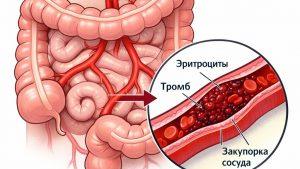 Тромбоз кишечника симптомы, причины и методы лечения