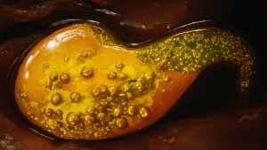 Густая желчь в желчном пузыре