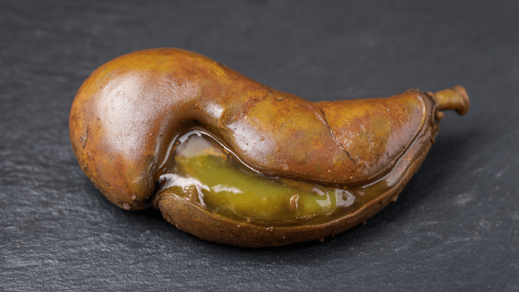 Густая желчь в желчном пузыре