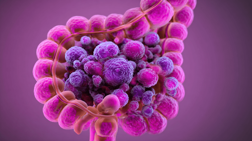 Свищ прямой кишки