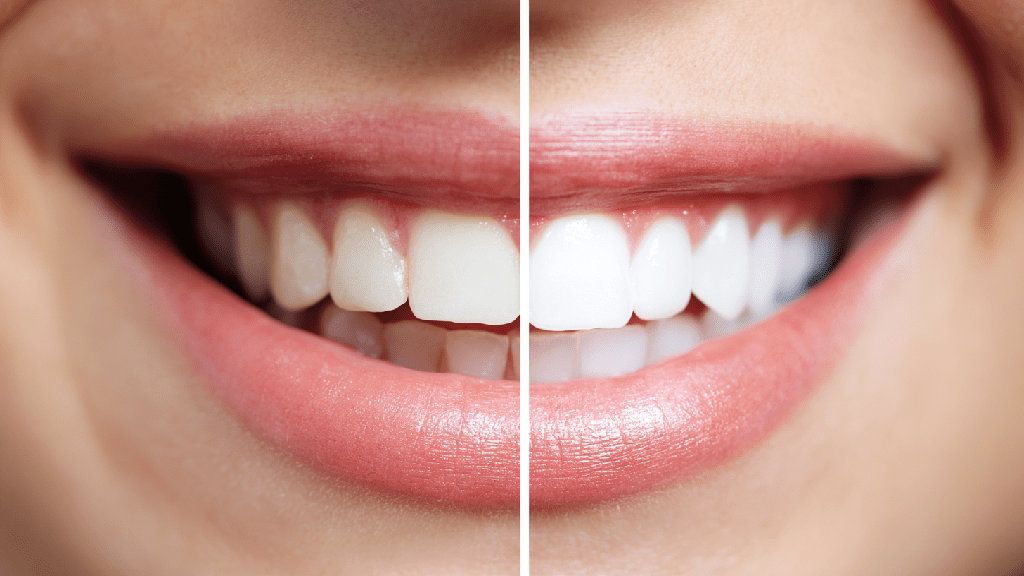 Белая диета после отбеливания зубов