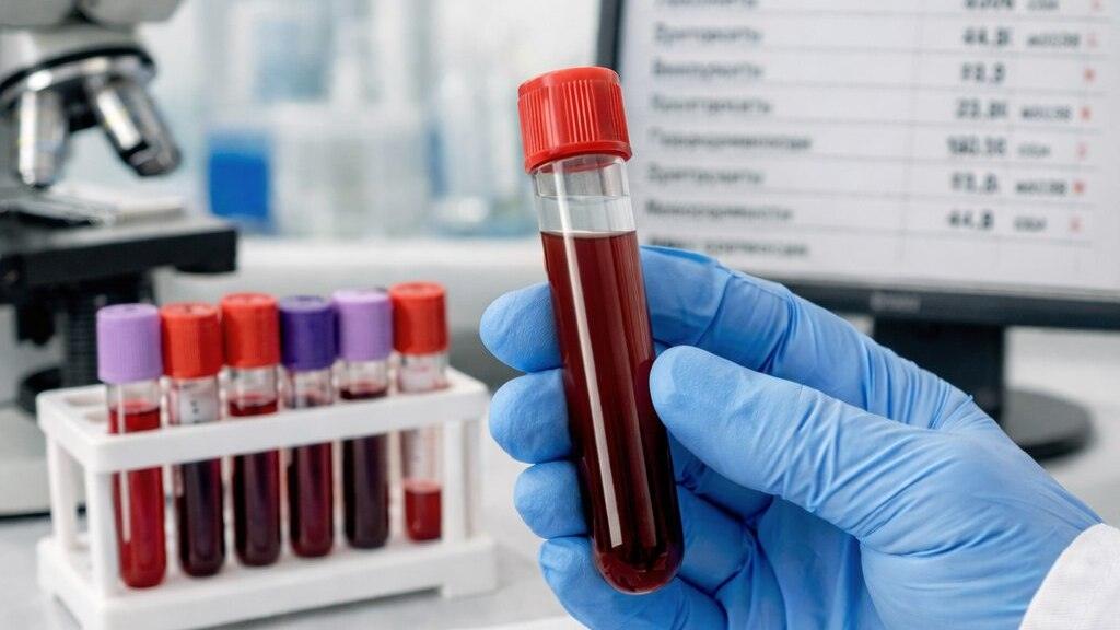 Диагностика анемического синдрома