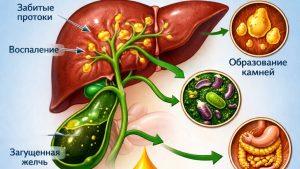 Холестаз симптомы, причины и лечение
