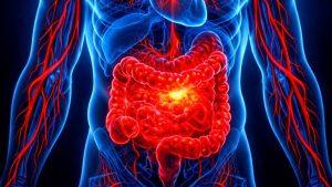 Хронический энтерит