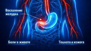 Хронический гастродуоденит