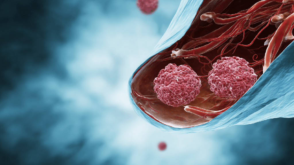 Дисфункциональное маточное кровотечение 
