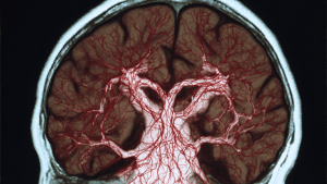 Хроническая ишемия головного мозга