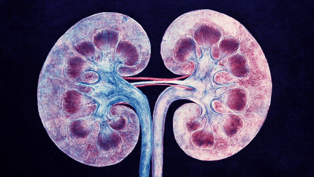 Гидронефроз почки
