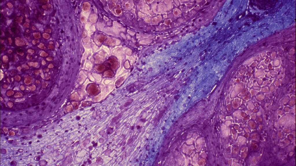 Гиперплазия эндометрия 

