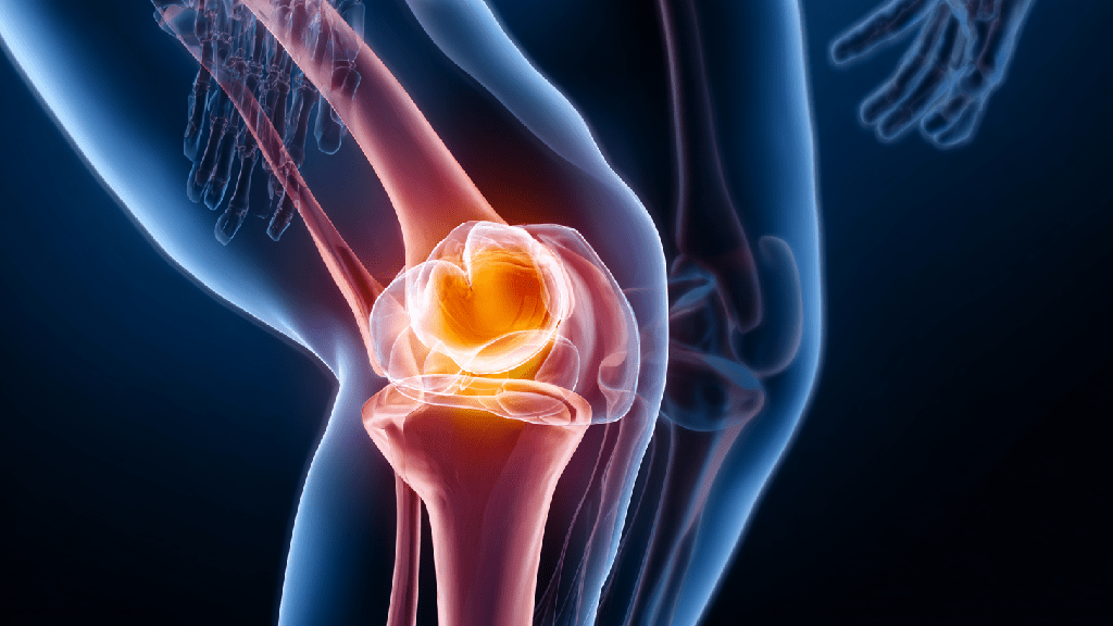 Остеоартроз
