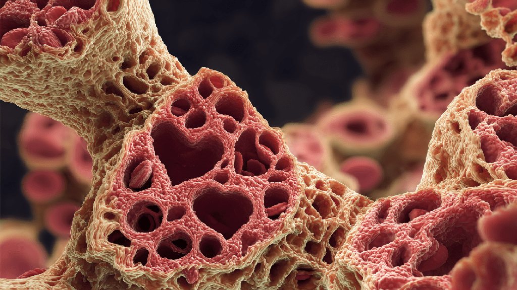 Бактериальный эндокардит
