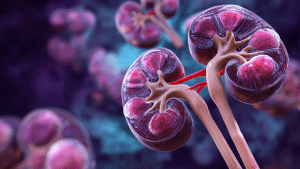 Поликистоз почек