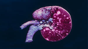 Спленомегалия